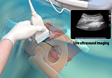 Ultrasound Guided Hip Injections