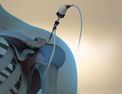 Arthroscopic surgery