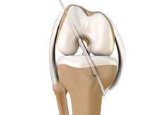 ACL Reconstruction