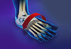 Ankle Instability Surgery