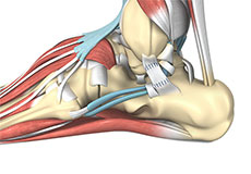 Ankle Ligament Reconstruction