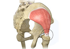 Gluteus Tendon Tear