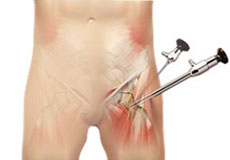 Hip Arthroscopy