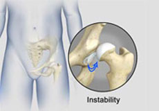 Hip Instability