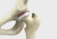 Hip Labral Tear