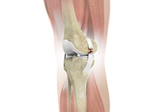 Knee Ligament Injuries