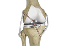 Knee Ligament Reconstruction