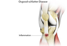 Osgood Schlatter Disease