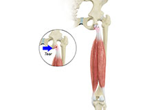 Proximal Hamstring Repair