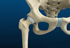 Stress Fractures of the Hip